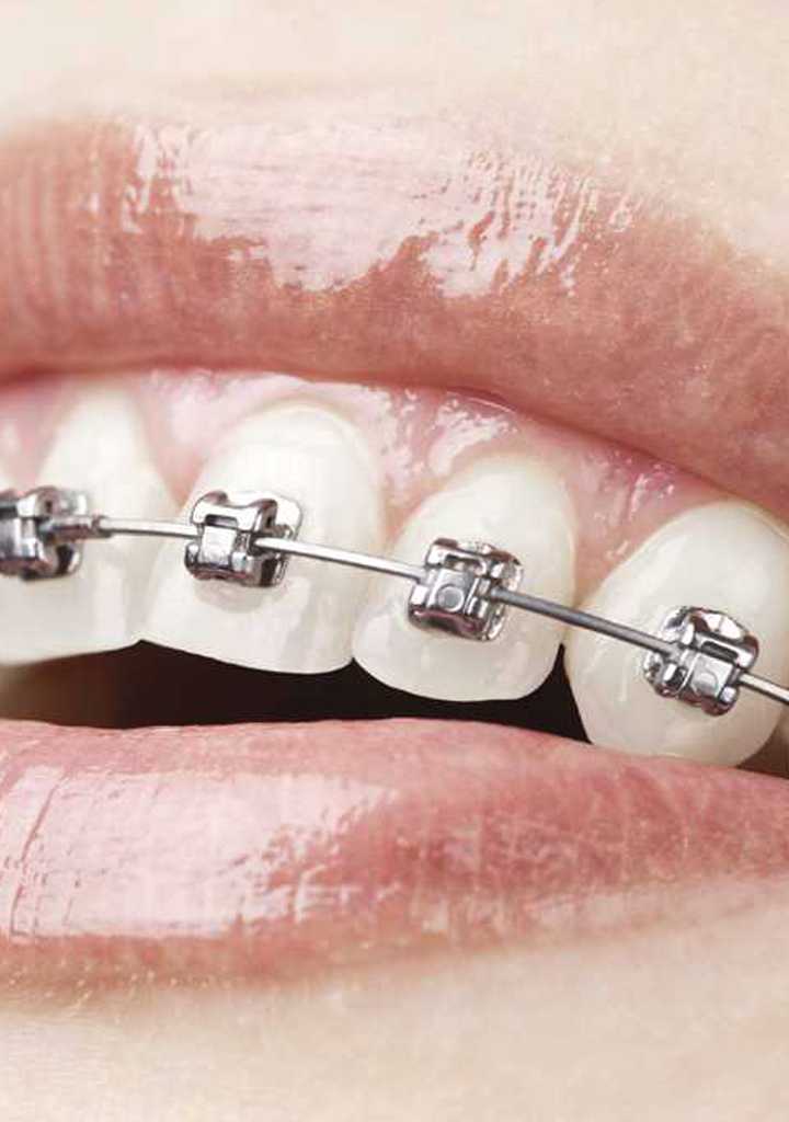 Scripps Ranch Braces, Poway Braces, San Diego Braces, Braces San Diego, San Diego Invisalign