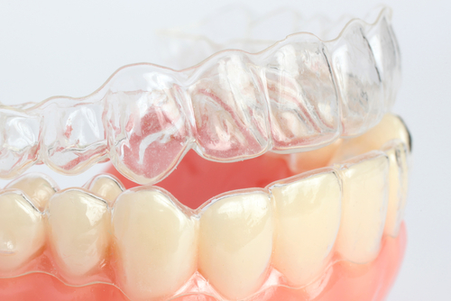 Scripps Ranch Braces, Poway Braces, San Diego Braces, Braces San Diego, San Diego Invisalign